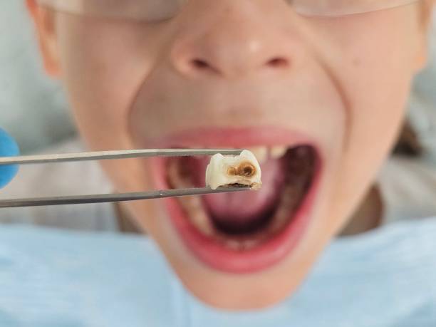 Best Emergency Treatment for Dental Infections or Abscesses in Rodney Village, DE